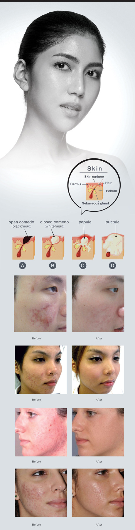 Acne Program 