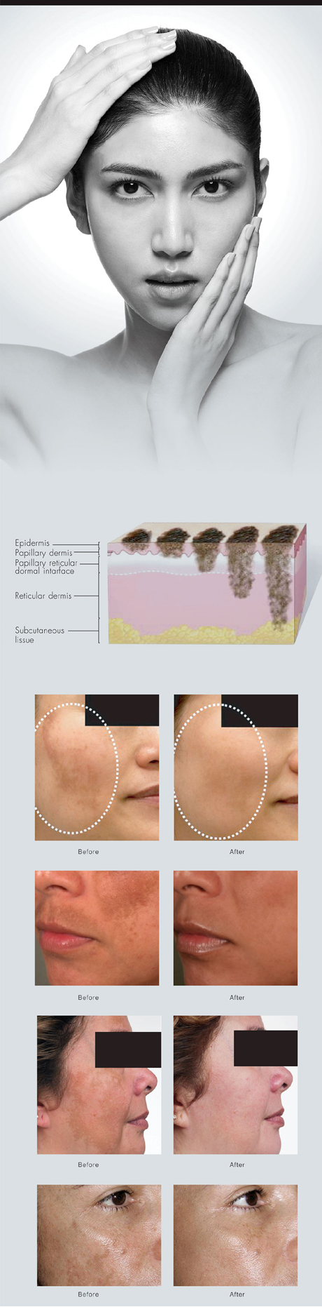 Melasma, Pigmentation